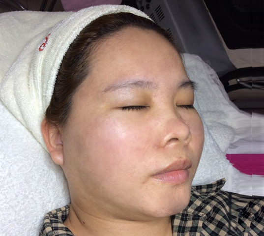 Khách hàng điều trị sẹo rỗ tại Jenna Thanh