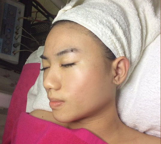 Khách hàng điều trị sẹo rỗ tại Jenna Thanh