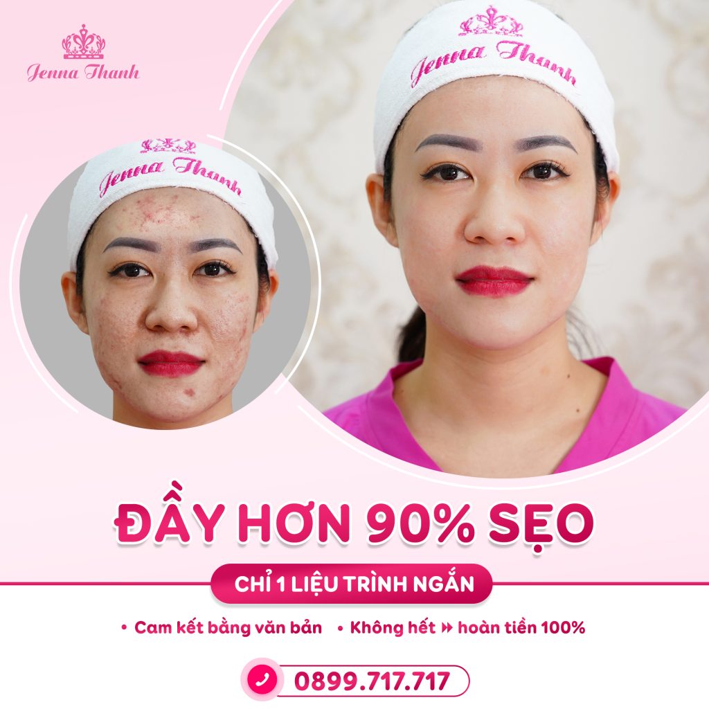 Lấp đầy sẹo hơn 90% chỉ qua 1 liệu trình ngắn