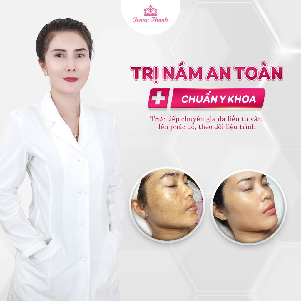 Điều trị nám an toàn cùng với chuyên gia da liễu