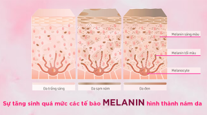 Sự tăng sinh quá mức của tế bào melanin hình thành nám da