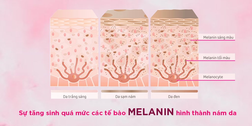 su tang sinh qua muc cua te bao melanin hinh thanh nam da