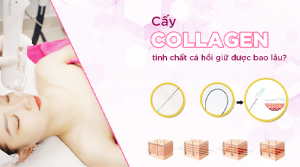 Cấy collagen tinh chất cá hồi giữ được bao lâu