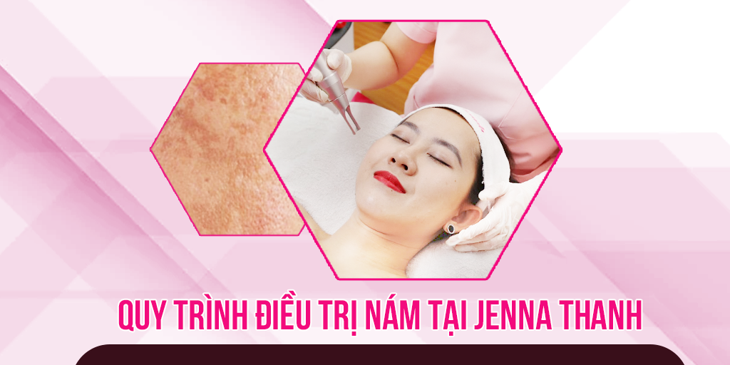 Quy trình điều trị nám tại Jenna Thanh