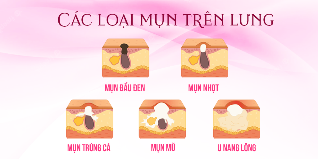 Các loại mụn trên lưng