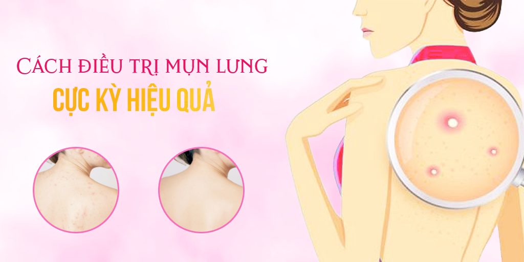 Cách điều trị mụn lưng cực kỳ hiệu quả