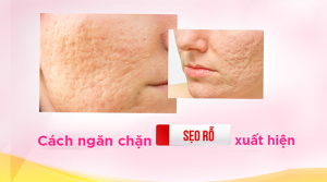 Cách ngăn chặn sẹo rỗ xuất hiện