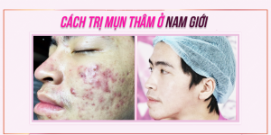 Cách điều trị mụn thâm ở nam giới