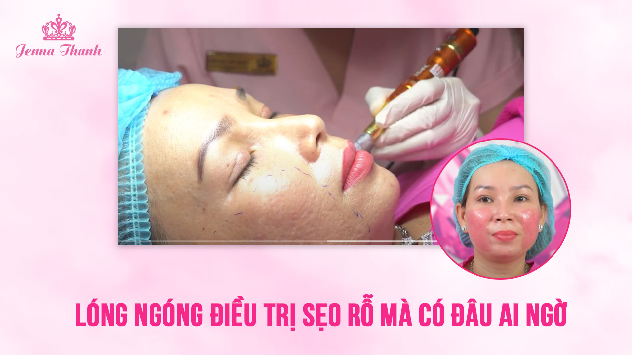 Chị Dung - điều trị sẹo rỗ tại Jenna Thanh chỉ sau 14 ngày