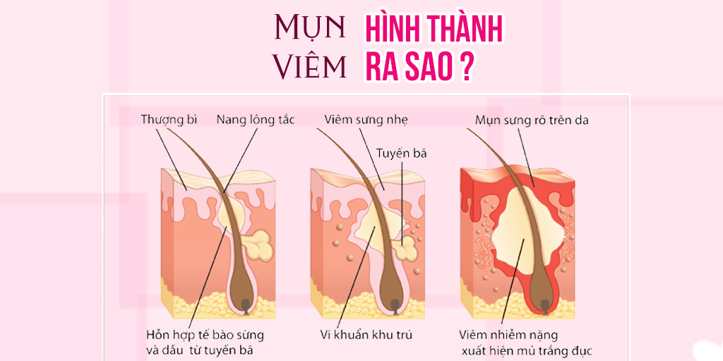 Mụn viêm hình thành ra sao?