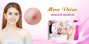 Mụn viêm làm sao để hết sạch vĩnh viễn