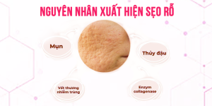 Nguyên nhân xuất hiện sẹo rỗ