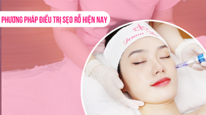 Phương pháp điều trị sẹo rỗ hiện nay