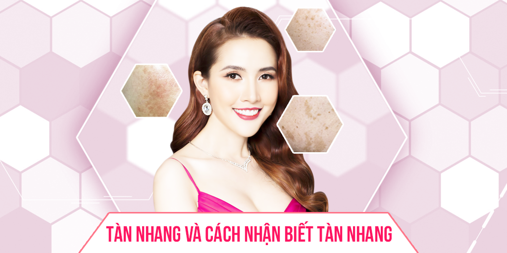 Tàn nhan và cách nhận biết tàn nhang