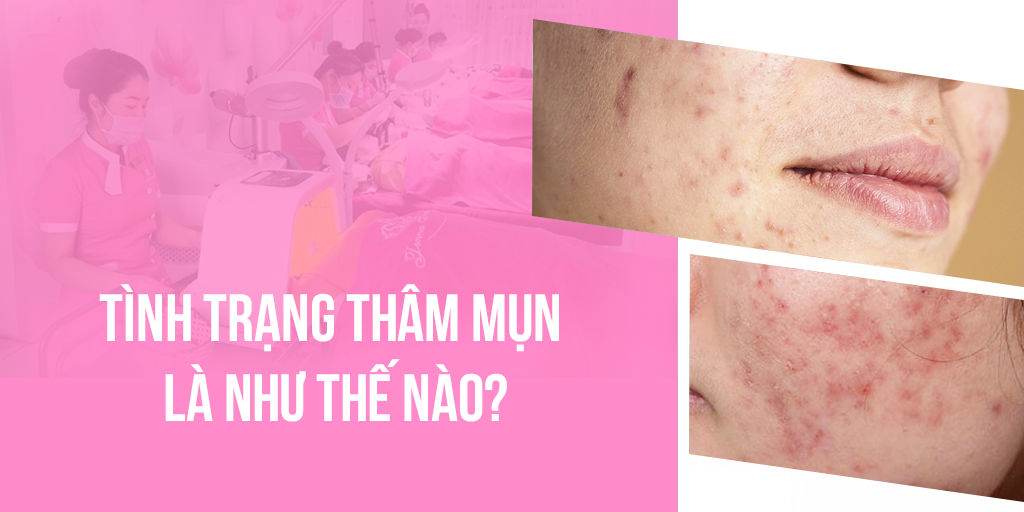 Tình trạng thâm mụn là như thế nào