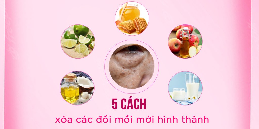 5 cách xóa đồi mồi mới hình thành