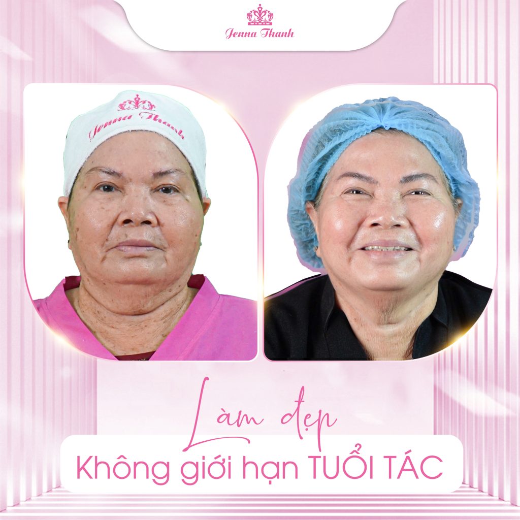 Điều trị đồi mồi - làm đẹp không giới hạn tuổi tác