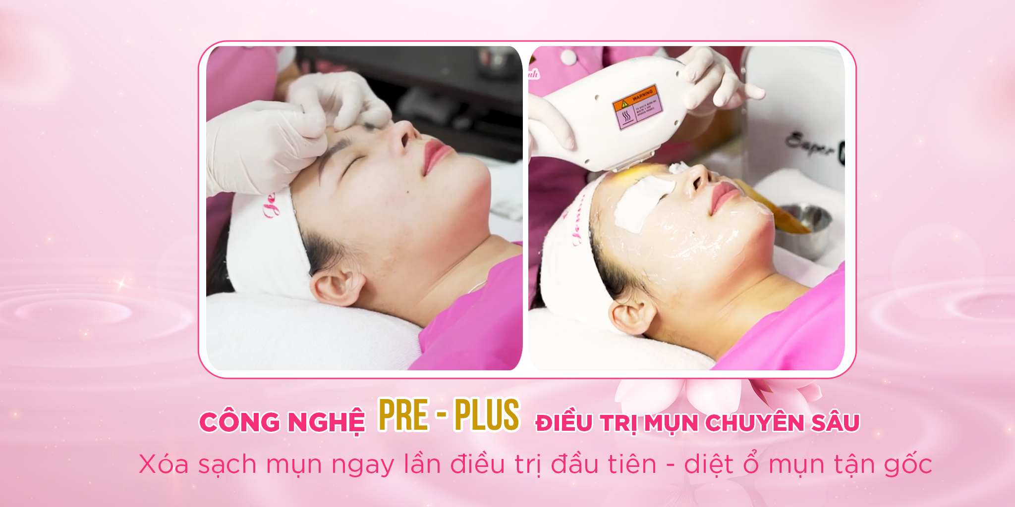 Công nghệ Pre Plus điều trị mụn viên chuyên sâu