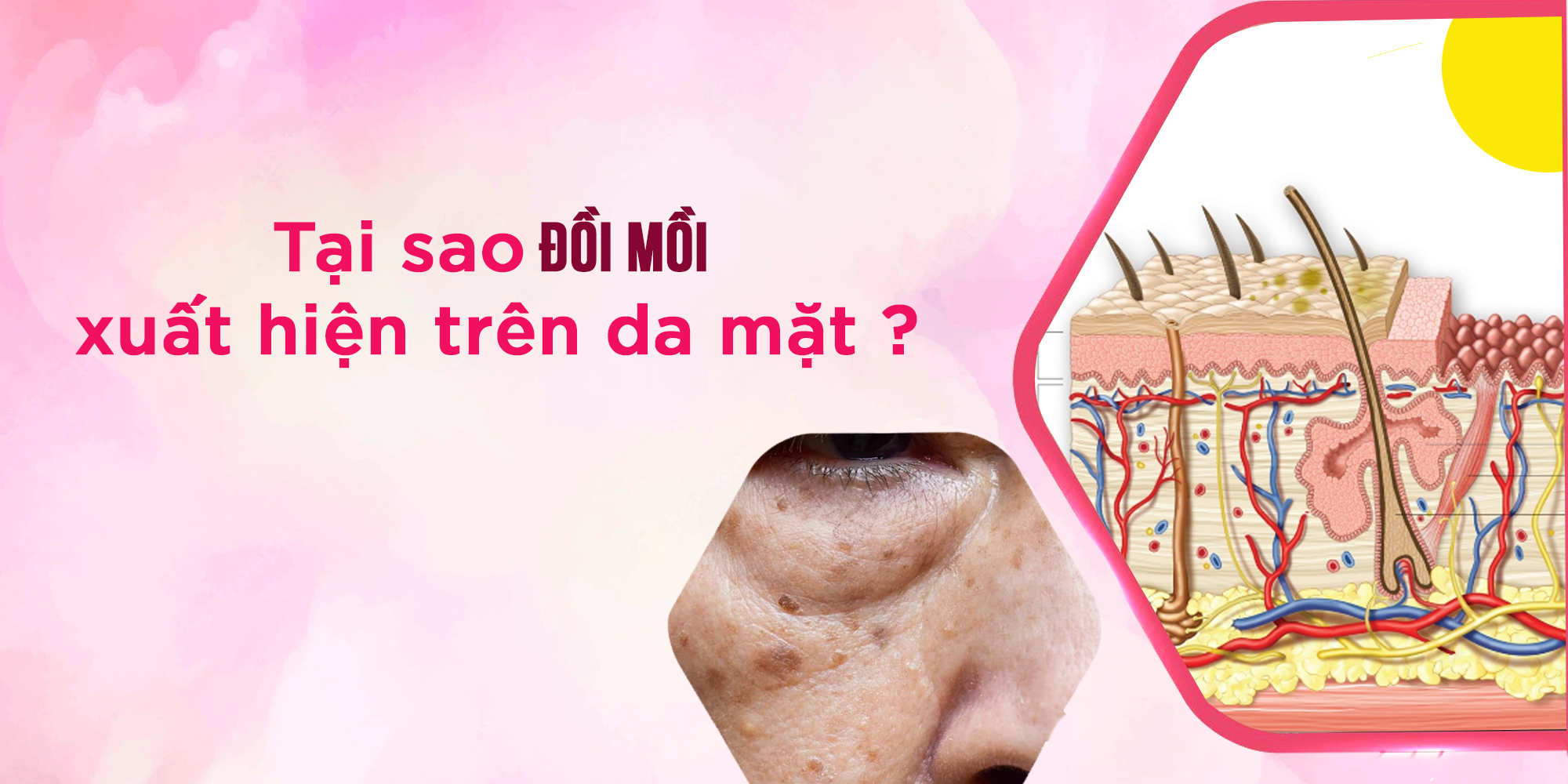 Tại sao đồi mồi xuất hiện trên da mặt