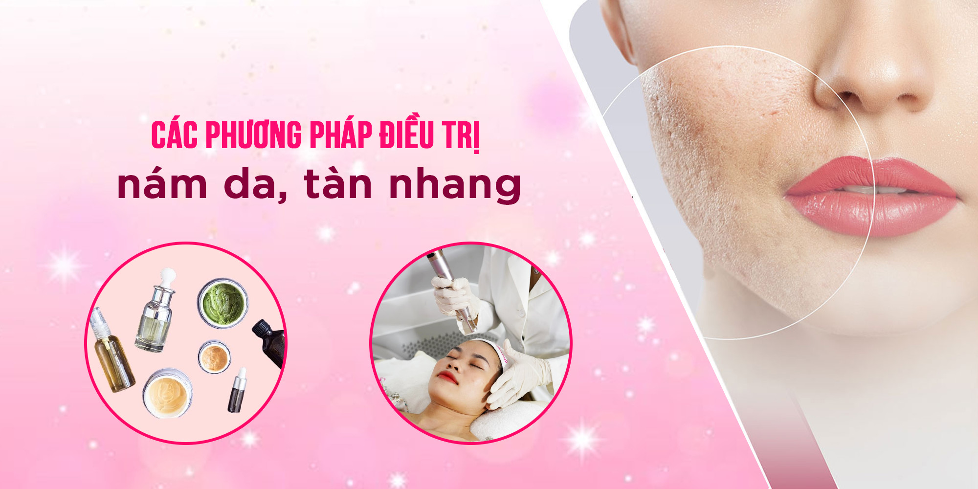 Các phương pháp điều trị nám da tàn nhang