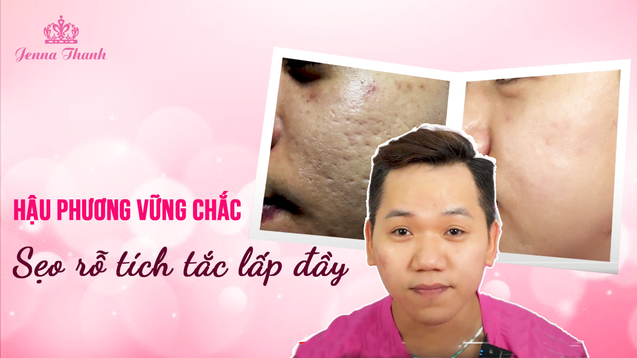 Hậu phương vững chắc sẹo rỗ tích tắc lấp đầy