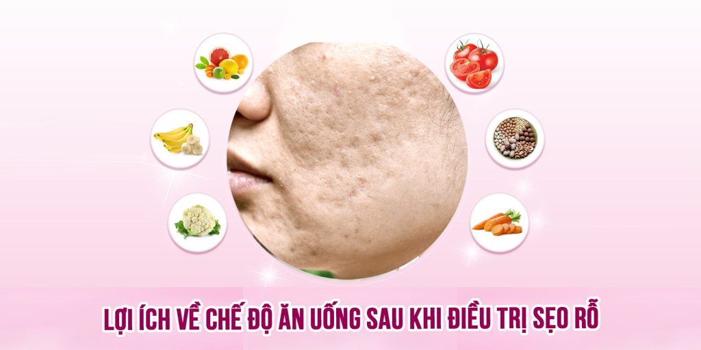 Lợi ích về chế độ ăn uống sau khi điều trị sẹo rỗ