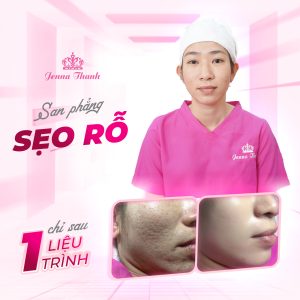 san phẳng sẹo rỗ chỉ 1 liệu trình