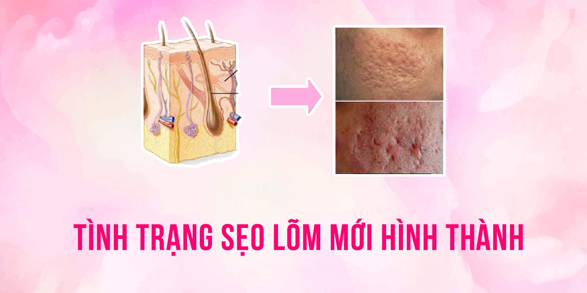 Tình trạng sẹo lõm mới hình thành