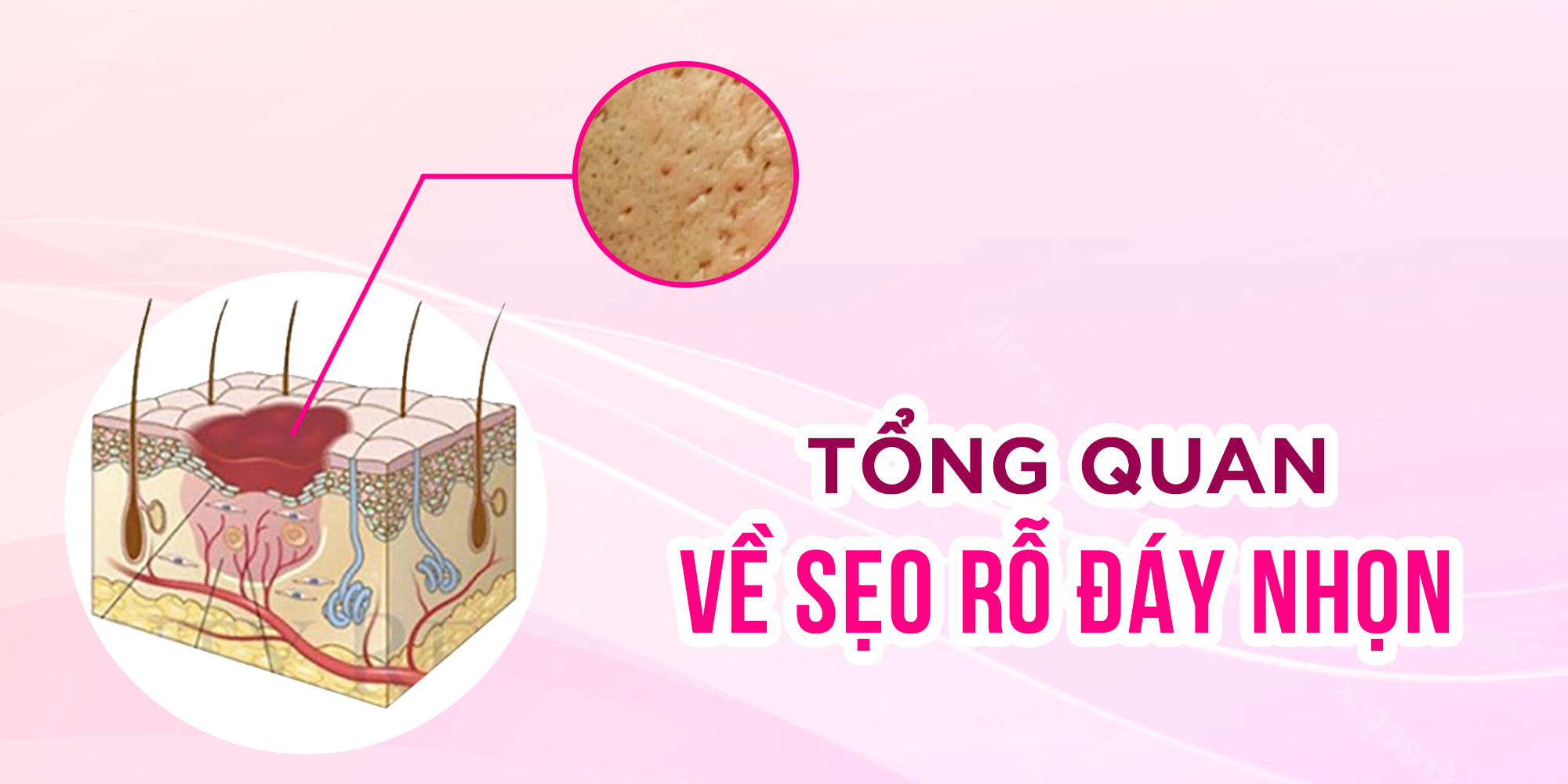 sẹo rỗ đáy nhọn