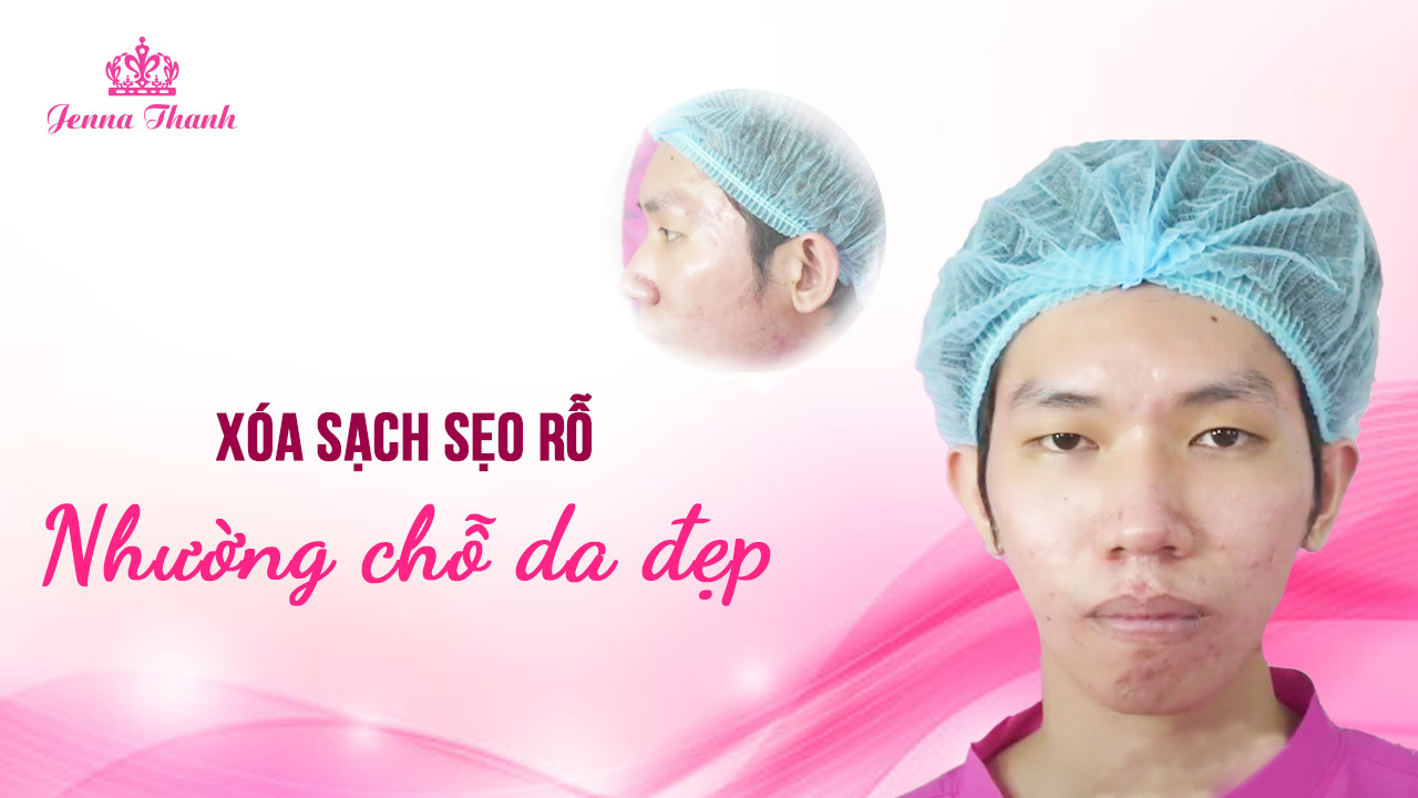 Xóa sạch sẹo rỗ nhường chỗ da đẹp